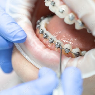 Acelerador de tratamientos de ortodoncia