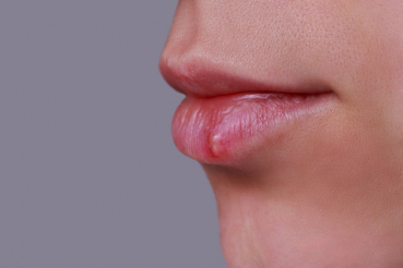 Herpes labial