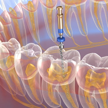 Endodoncias rotatorias