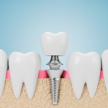 Implantes dentales